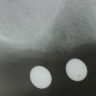 Exemple 12: Ici la pose de deux implants est envisagée, mais la hauteur d'os est insuffisante pour le deuxième implant. Le sinus (qui est une cavité creuse) est à moins de 6 mm de la surface de l'os. Idéalement il faudrait 10 mm d'os.