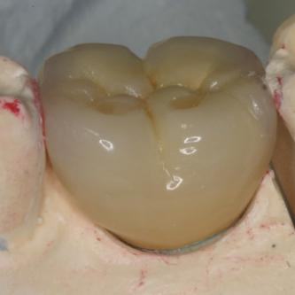 Exemple 5: La couronne céramique est réalisée au laboratoire.