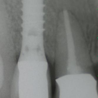 Exemple 3: Puis sur ce moignon, la couronne en céramique est scellée.