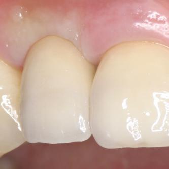 Exemple3: La couronne en place.