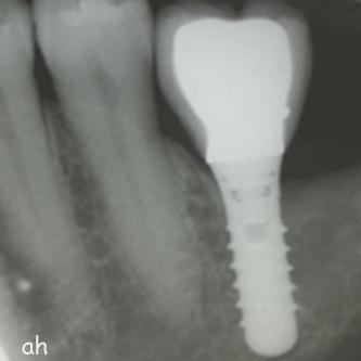 Exemple 7: La couronne en place