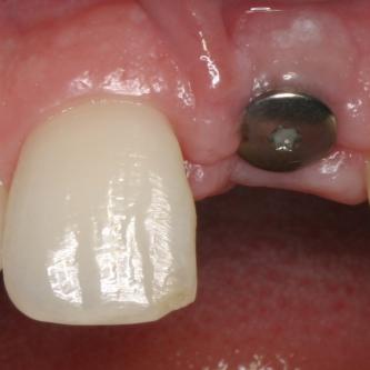 Exemple 1: Ce patient a perdu son incisive centrale gauche lors d'un accident. Un implant a été posé