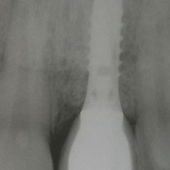 Exemple 1: L'implant s'est intégré dans l'os, une empreinte est effectuée. Le laboratoire peut réaliser la couronne en céramique.