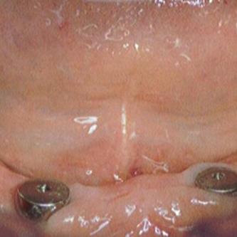 Exemple 9: Un cas complexe, 3 implants on été mis au niveau de la mandibule.