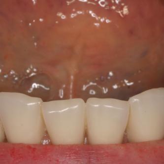 Exemple 9: Puis un appareil amovible est fixé sur cette barre.