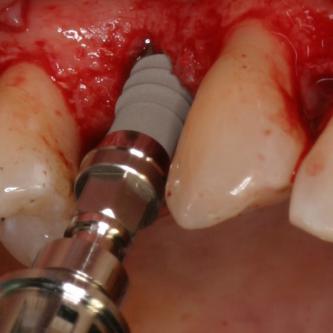 Exemple 10: En cours d'implantation