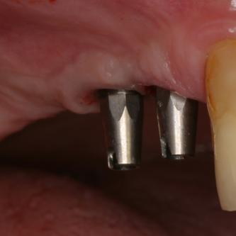 Exemple 12: Les moignons vissés sur les implants 6 mois plus tard.