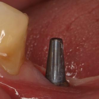 Exemple 7: Le moignon vissé sur l'implant.