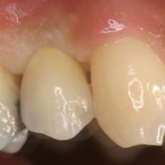 Exemple 8: La couronne en place.