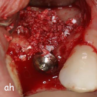 Exemple 11: Une greffe d'os est effectuée afin de compenser l'épaisseur d'os manquante.