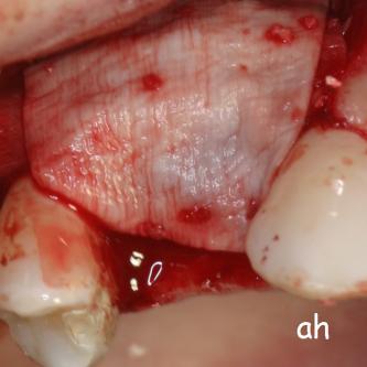 Exemple 11: Le tout est recouvert d'une membrane collagène.