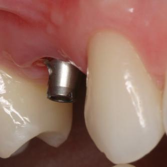 Exemple 11: Après cicatrisation environ 6 mois, le moignon est vissé sur l'implant.