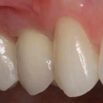 Exemple 11: La couronne céramique en place.