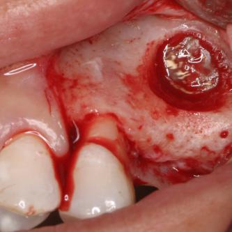 Exemple 14: Un petit puits d'accès est créé afin d'atteindre le sinus, notez la membrane sinusienne.