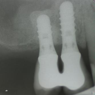 Exemple 12: Les couronnes en place.