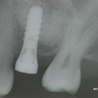 Exemple 14: 6 mois plus tard, l'implant est introduit dans cette greffe sans toucher le sinus.