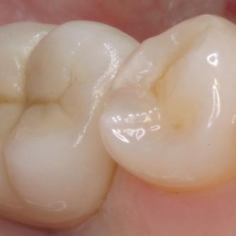 Exemple 2: La couronne en céramique scellée sur cet implant.