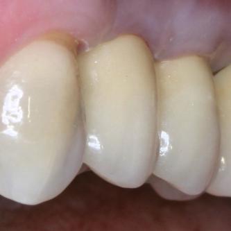Exemple 4: La couronne céramique sur l'implant.