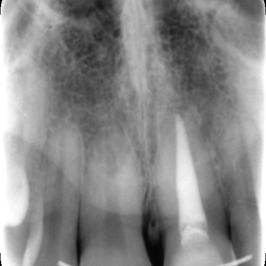 Un ancien traitement de racine est présent sur l'incisive gauche