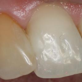 Discoloration due à un traitement de racine