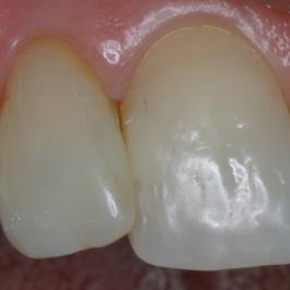 Après 1 mois et 2 séances de blanchiment interne